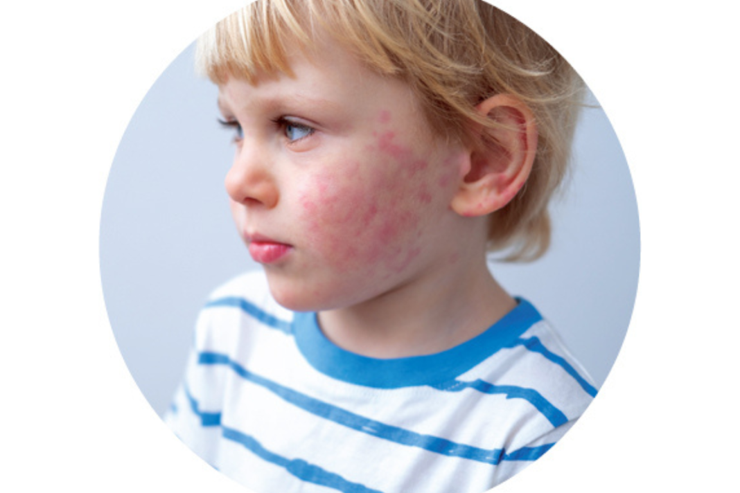 peanut and egg allergies